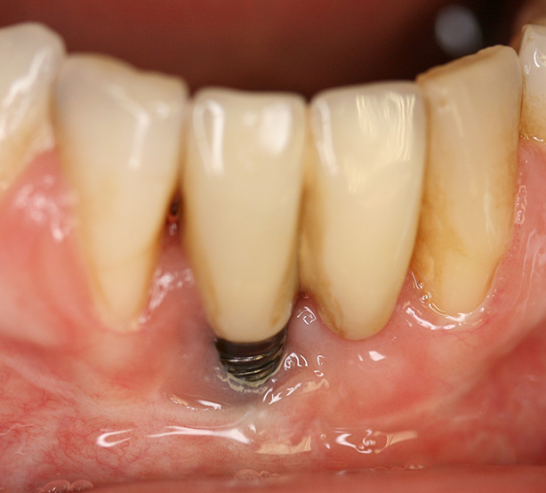 Periimplantitisbehandlung Periimplantitisbehandlung