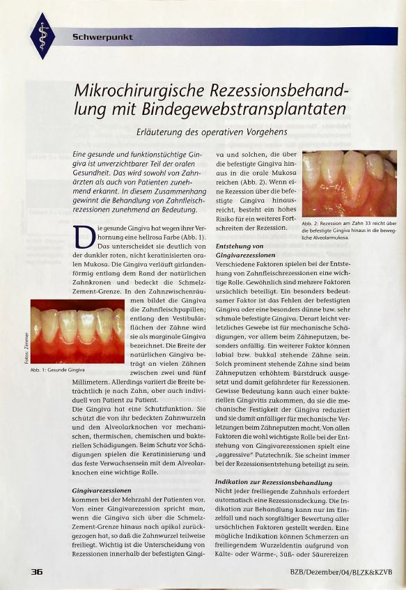 Erläuterung des operativen Vorgehens bei der mikrochirurgischen Rezessionsbehandlung mit Bindegewebstransplantaten.